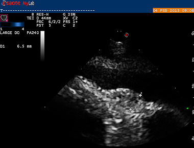 Small 6mm suspicious area at the level of the junction between the right atrium and right ventricle