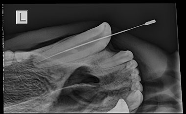 Arktos HWP Left Upper Canine Pulp Cavity