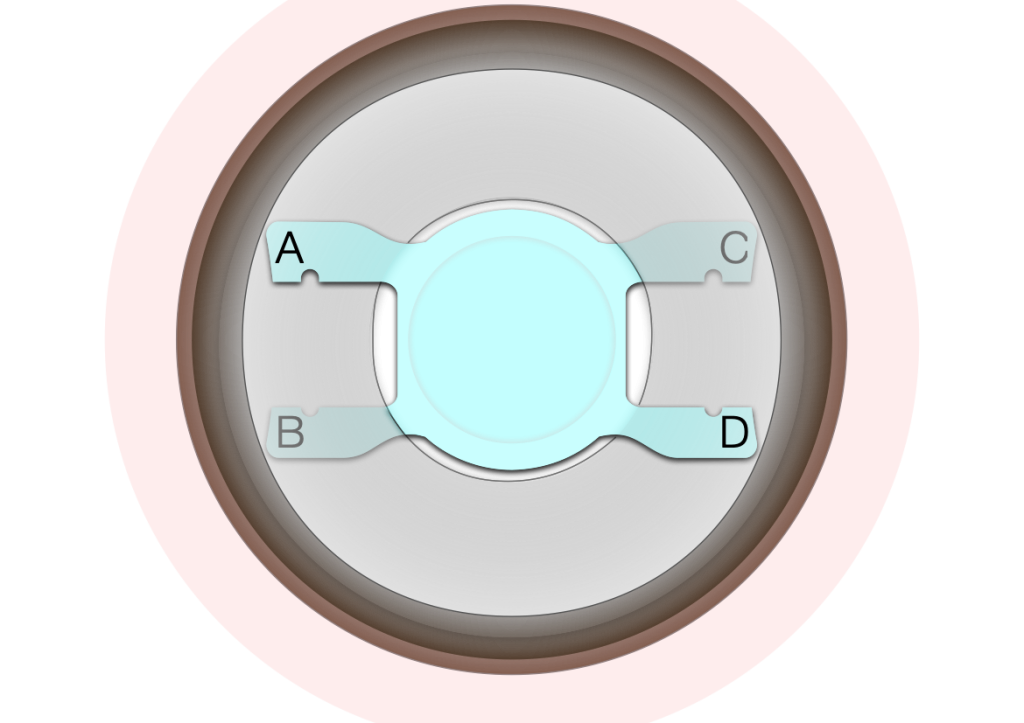 A diagram showing how the novel cataract surgery works.