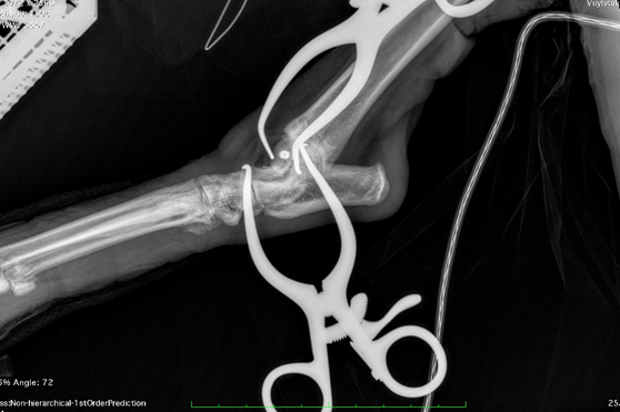 The fracture’s small size, delicate location, and proximity to the joint meant precision was critical