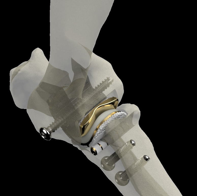 TATE elbow replacement implant placed in elbow