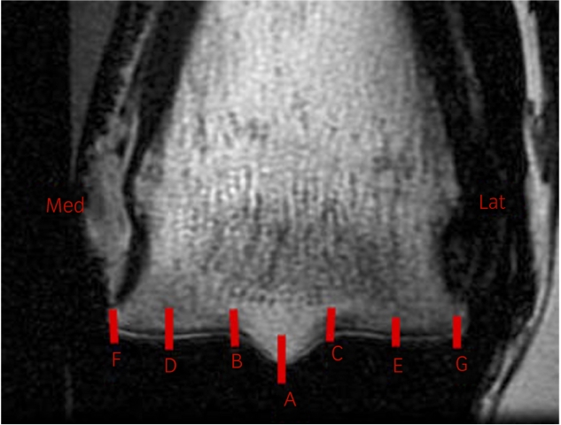 Increases in subchondral bone thickness measured from MRI images were associated with increased fracture risk.