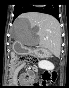 CT image showing a normal looking liver on the right compared to the abnormal side towards the left of the picture.
