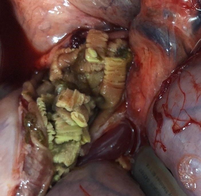 Live tapeworm infection discovered 4 days after receiving praziquantel tapeworm treatment