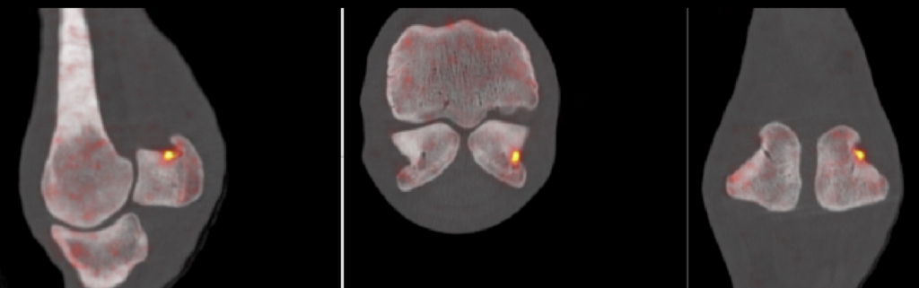 PETCT: PET is the most recent advance in diagnostic imaging. It is being developed in California and, when combined with CT, provides information on bone activity and structure. In these 3 images of  the same fetlock from different aspects, the orange spo