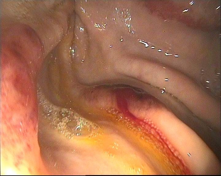  Haemorrhagic EGGD lesions