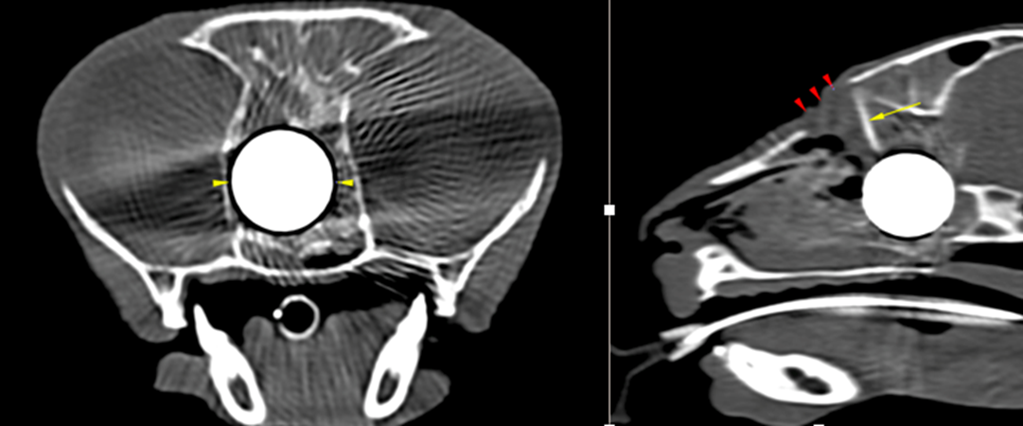 Ct scan revelas ball bearing in frontal signus