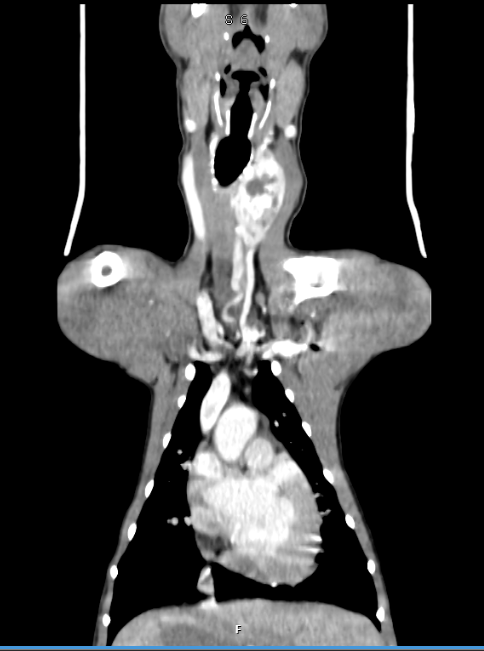 A CT scan showing the tumour on little Lenny&#39;s neck