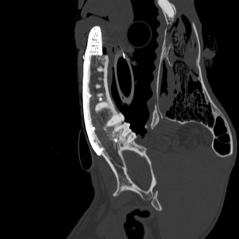 CT image following jaw reconstruction with a 3D printed titanium patient specific implant