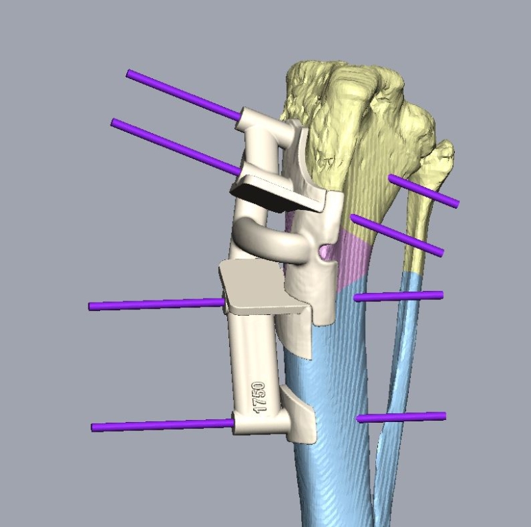 Image showing the 3D customised bone guides used in Yana’s surgery.