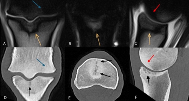 Figure 1: Frontal T2*W gradient echo (GRE) (A) and short tau inversion recovery (STIR) (B) and sagittal T2*W GRE magnetic resonance images (C) and frontal (D), transverse (E) and sagittal (F) computed tomographic (CT) reconstructions of the right forelimb